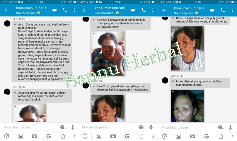 Cara Mengobati Herpes Agar Cepat Ker