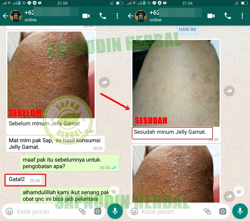 Cara Mengobati Herpes Agar Cepat Kering