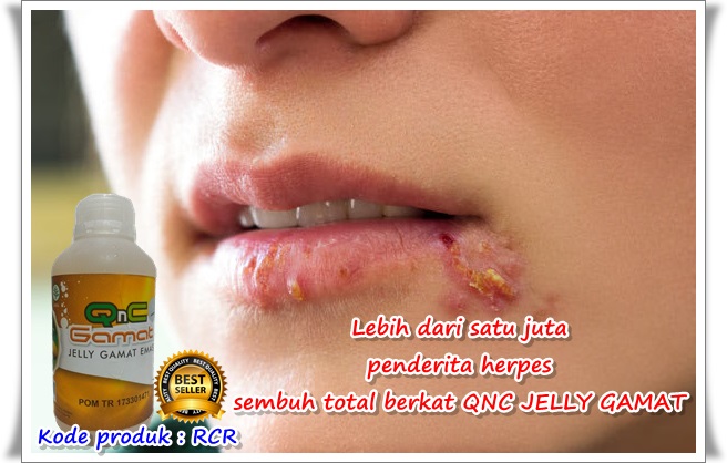 Cara Mengobati Herpes