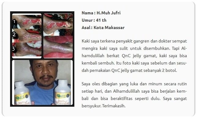 Cara Mengobati Herpes Agar Cepat Kering