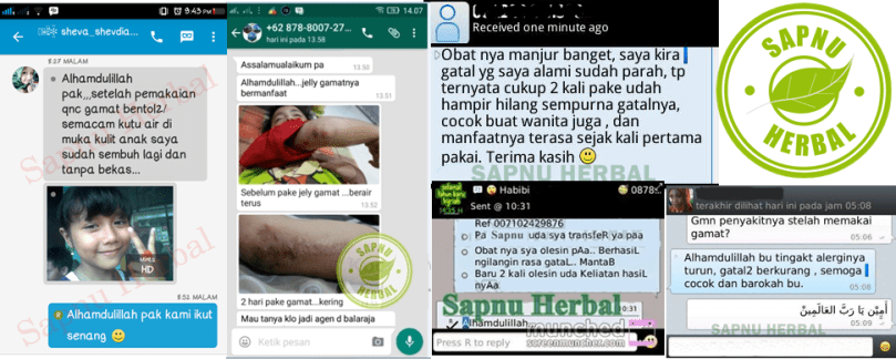 Cara Mengobati Herpes Agar Cepat Ke